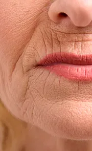 Endymed, Endymed pro, Endymed Pure, Radiofrequência, 3DEEP, iFINE, Intensif, Mini Shaper, Small, Contour, Shaper, FSR, SKIN RESURFACING, BODY CONTOURING, FACIAL TIGHTENING, MICROAGULHAMENTO DE OURO